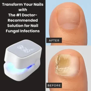Nexisify®- Nail fungus cleaning laser device