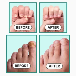 Nexisify®- Nail fungus cleaning laser device